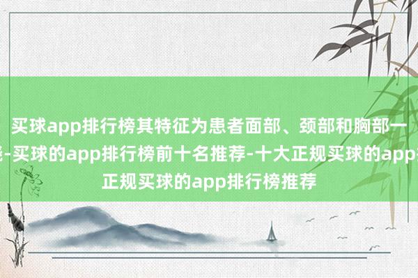 买球app排行榜其特征为患者面部、颈部和胸部一刹感到发烧-买球的app排行榜前十名推荐-十大正规买球的app排行榜推荐